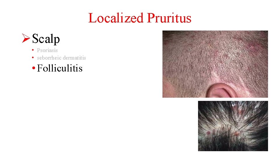 Localized Pruritus ØScalp • Psoriasis • seborrheic dermatitis • Folliculitis 