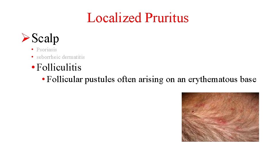 Localized Pruritus ØScalp • Psoriasis • seborrheic dermatitis • Folliculitis • Follicular pustules often