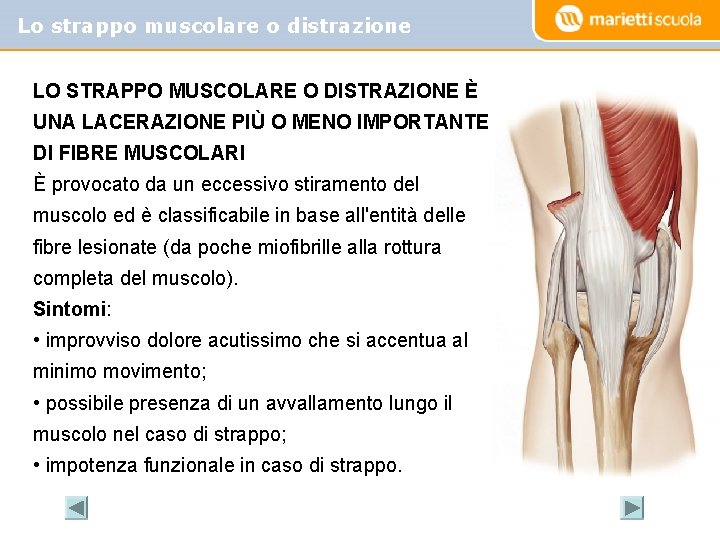 Lo strappo muscolare o distrazione LO STRAPPO MUSCOLARE O DISTRAZIONE È UNA LACERAZIONE PIÙ