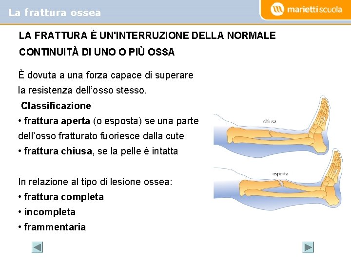 La frattura ossea LA FRATTURA È UN'INTERRUZIONE DELLA NORMALE CONTINUITÀ DI UNO O PIÙ