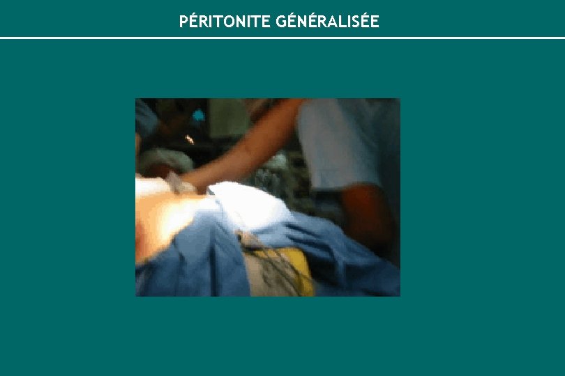 PÉRITONITE GÉNÉRALISÉE 