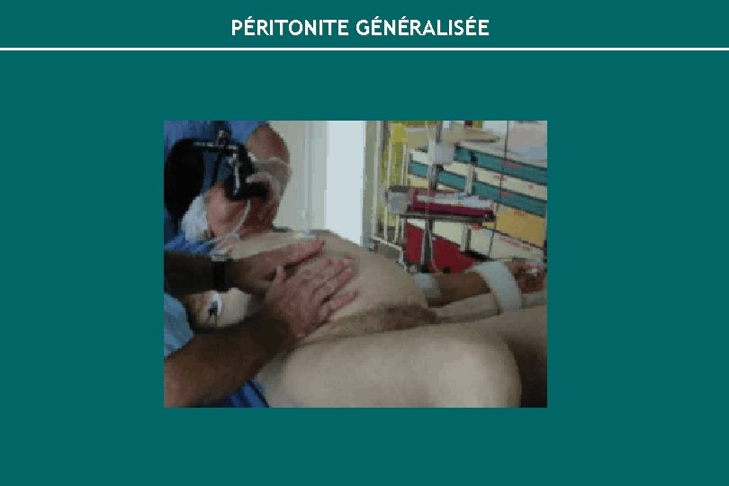 PÉRITONITE GÉNÉRALISÉE 