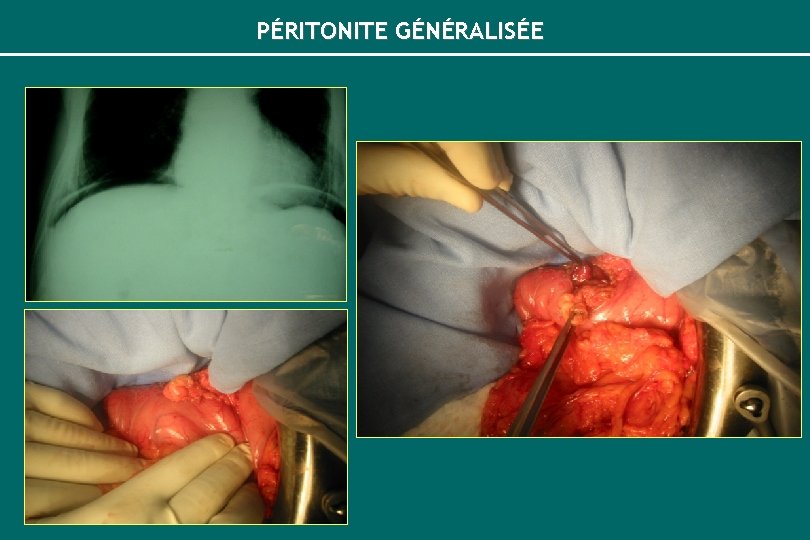 PÉRITONITE GÉNÉRALISÉE 