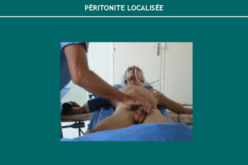 PÉRITONITE LOCALISÉE 