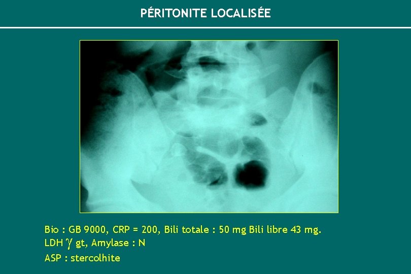 PÉRITONITE LOCALISÉE Bio : GB 9000, CRP = 200, Bili totale : 50 mg
