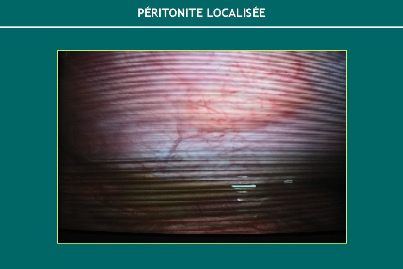 PÉRITONITE LOCALISÉE 