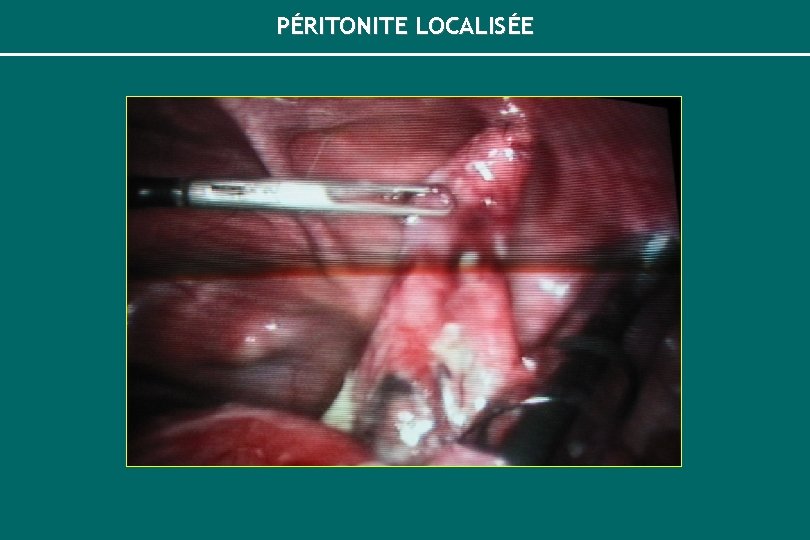 PÉRITONITE LOCALISÉE 
