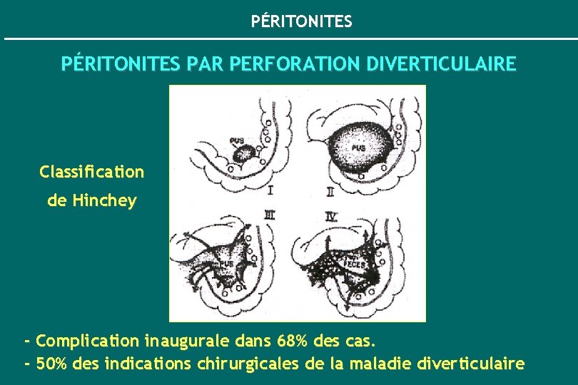PÉRITONITES PAR PERFORATION DIVERTICULAIRE Classification de Hinchey - Complication inaugurale dans 68% des cas.