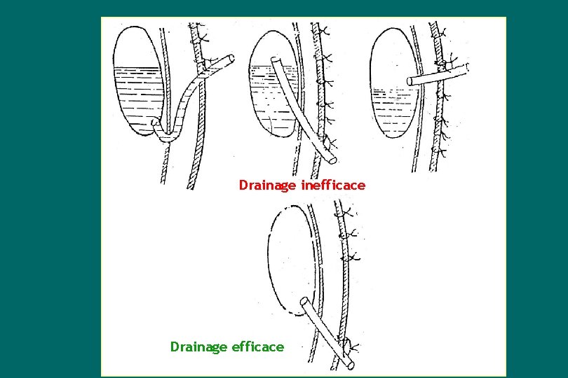 Drainage inefficace Drainage efficace 