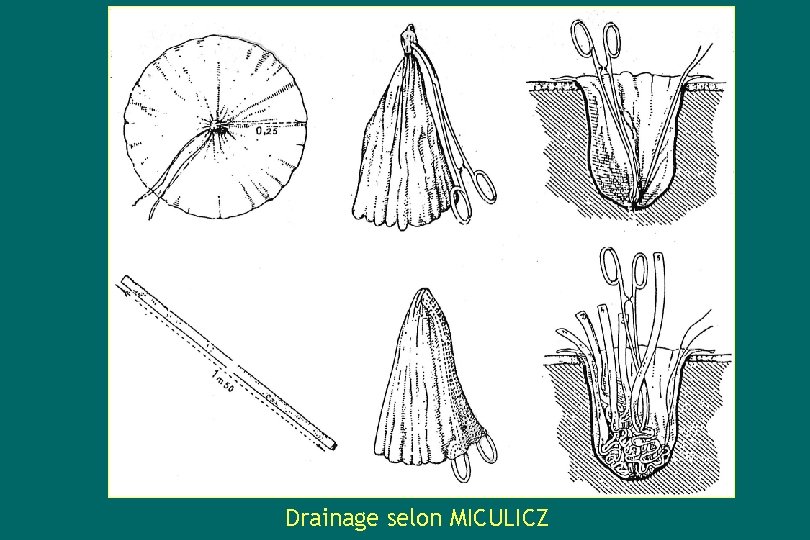 Drainage selon MICULICZ 