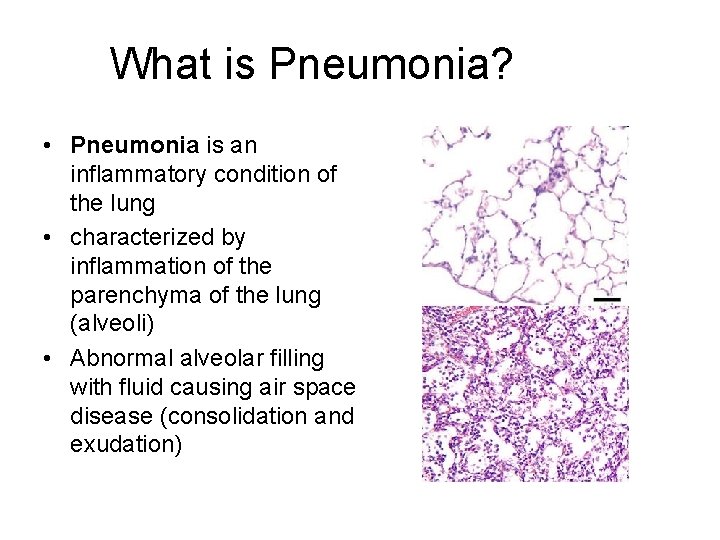 What is Pneumonia? • Pneumonia is an inflammatory condition of the lung • characterized