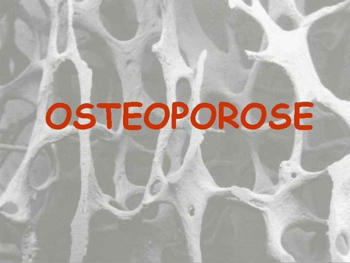 OSTEOPOROSE OSTEOPOROSE