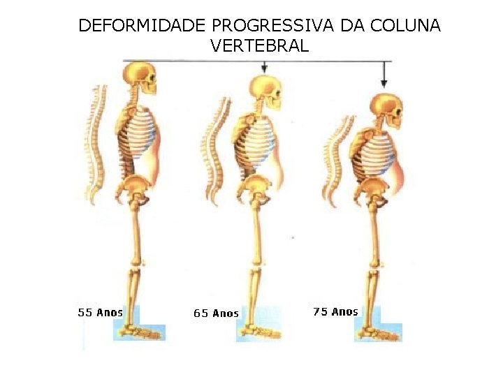 DEFORMIDADE PROGRESSIVA DA COLUNA VERTEBRAL DEFORMIDADE PROGRESSIVA DA COLUNA VERTEBRAL