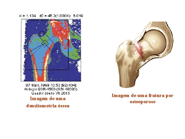 Imagem de uma densitometria óssea Imagem de uma fratura por osteoporose Imagem de uma densitometria óssea Imagem de uma fratura por osteoporose