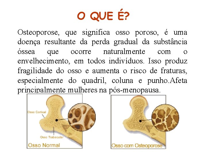O QUE É? Osteoporose, que significa osso poroso, é uma doença resultante da perda O QUE É? Osteoporose, que significa osso poroso, é uma doença resultante da perda