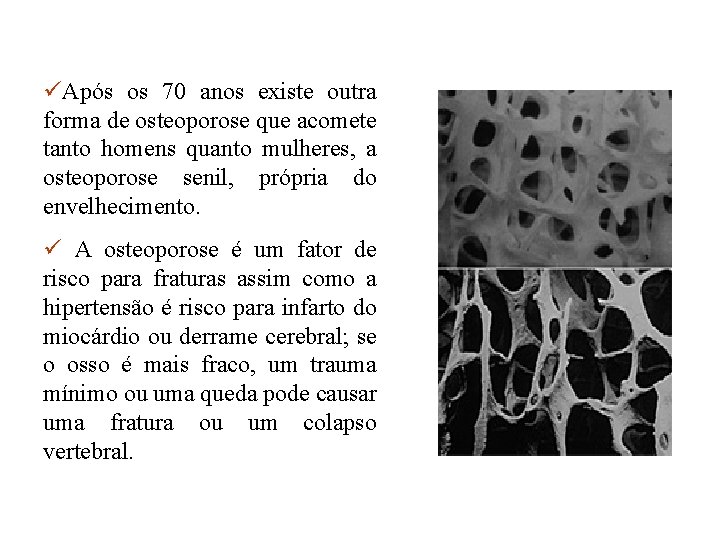 üApós os 70 anos existe outra forma de osteoporose que acomete tanto homens quanto üApós os 70 anos existe outra forma de osteoporose que acomete tanto homens quanto