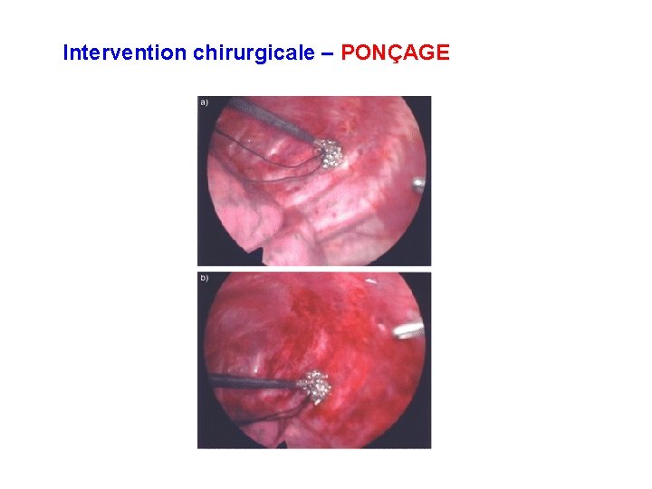 Intervention chirurgicale – PONÇAGE 