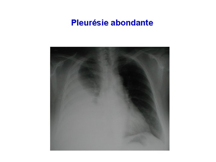 Pleurésie abondante 