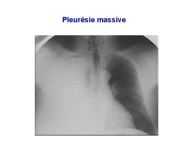 Pleurésie massive 