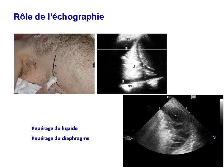 Rôle de l’échographie Repérage du liquide Repérage du diaphragme 