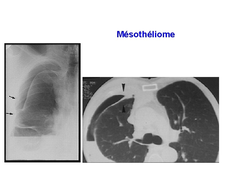 Mésothéliome 