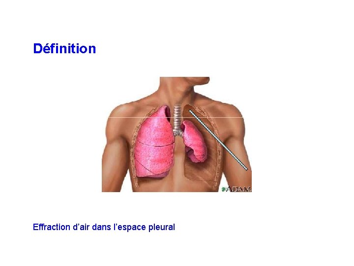 Définition Effraction d’air dans l’espace pleural 