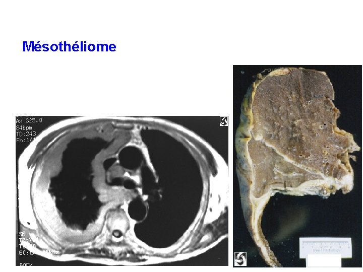 Mésothéliome 