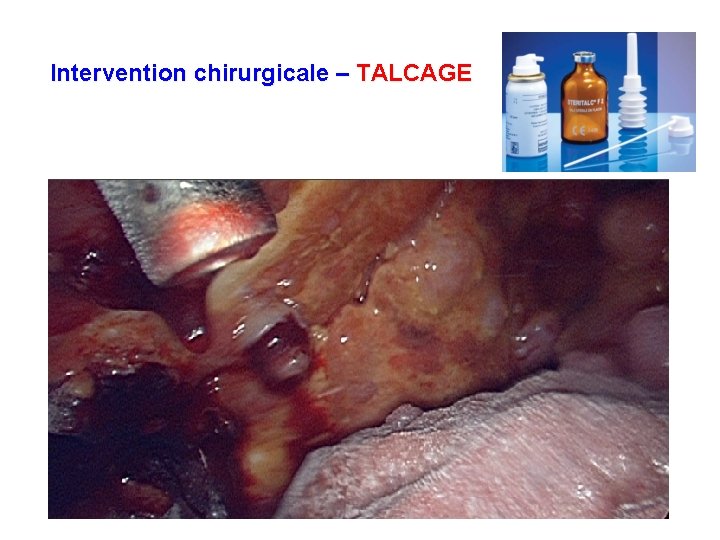 Intervention chirurgicale – TALCAGE 