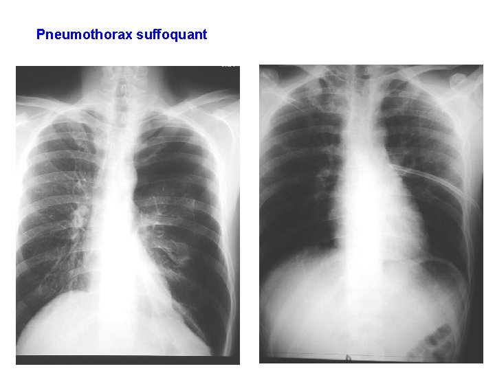 Pneumothorax suffoquant 