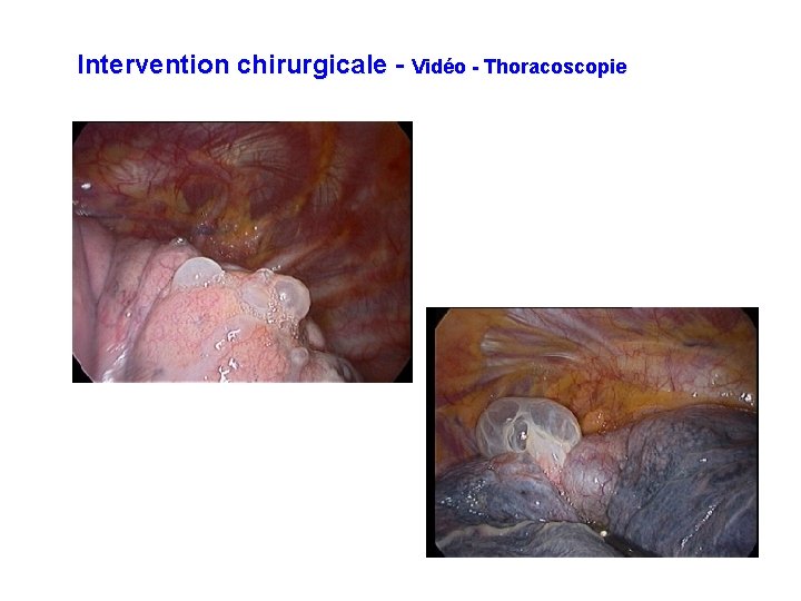 Intervention chirurgicale - Vidéo - Thoracoscopie 