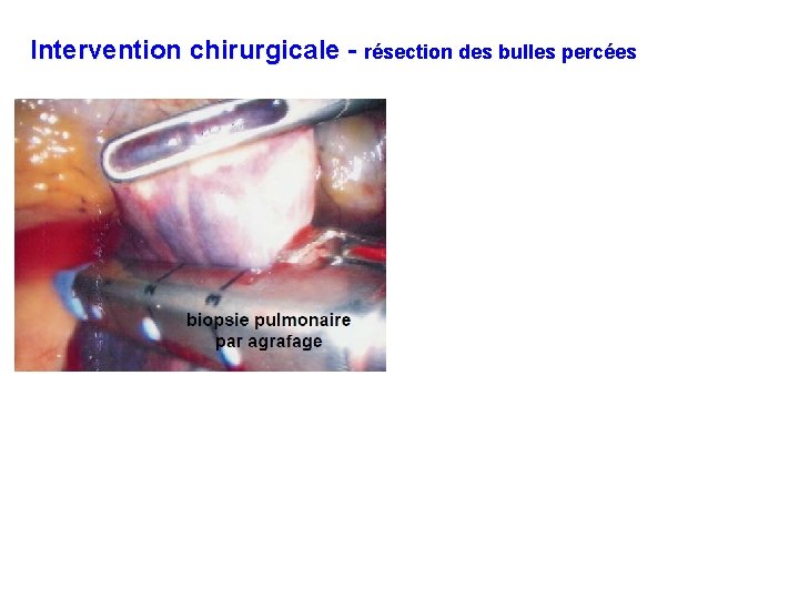Intervention chirurgicale - résection des bulles percées 