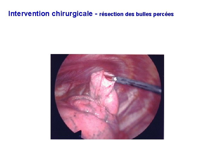 Intervention chirurgicale - résection des bulles percées 