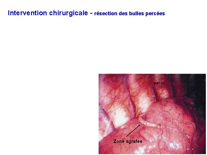 Intervention chirurgicale - résection des bulles percées 