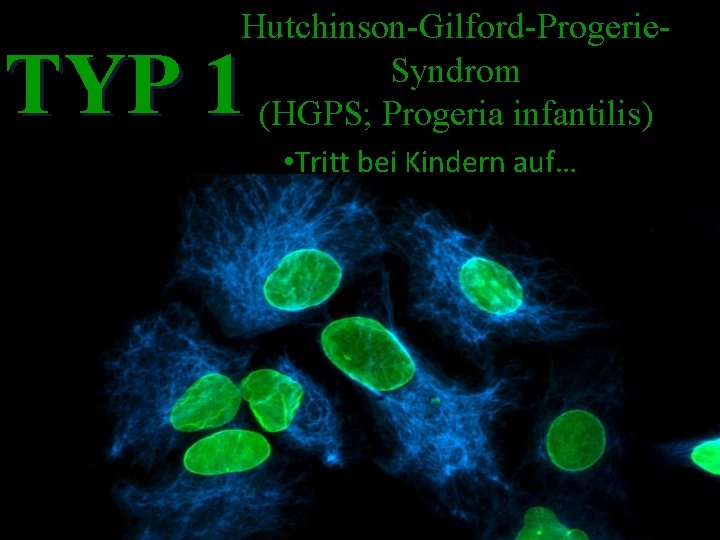 Hutchinson-Gilford-Progerie. Syndrom (HGPS; Progeria infantilis) TYP 1 • Tritt bei Kindern auf… 