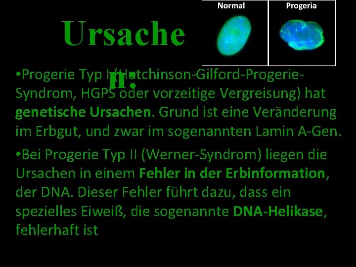 Ursache • Progerie Typ I (Hutchinson-Gilford-Progerien: Syndrom, HGPS oder vorzeitige Vergreisung) hat genetische Ursachen.