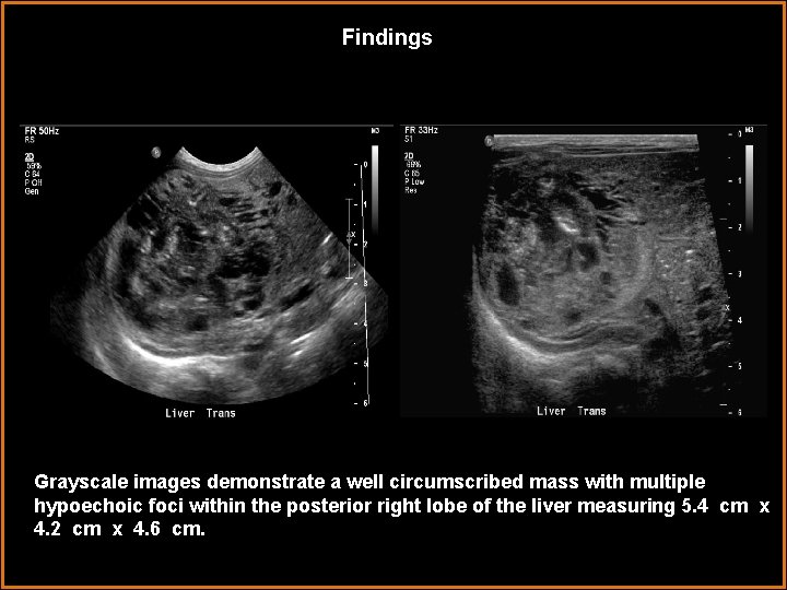 Findings Grayscale images demonstrate a well circumscribed mass with multiple hypoechoic foci within the