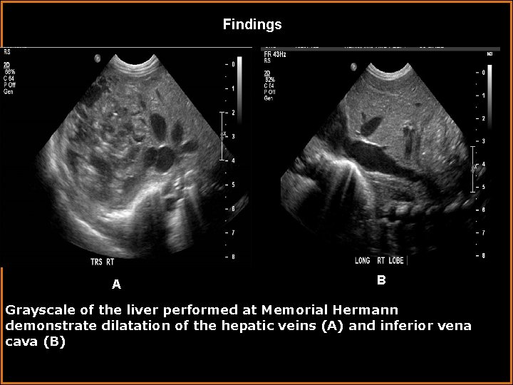 Findings A B Grayscale of the liver performed at Memorial Hermann demonstrate dilatation of