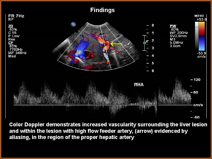 Findings ← Color Doppler demonstrates increased vascularity surrounding the liver lesion and within the