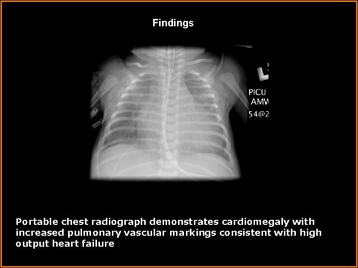 Findings Portable chest radiograph demonstrates cardiomegaly with increased pulmonary vascular markings consistent with high
