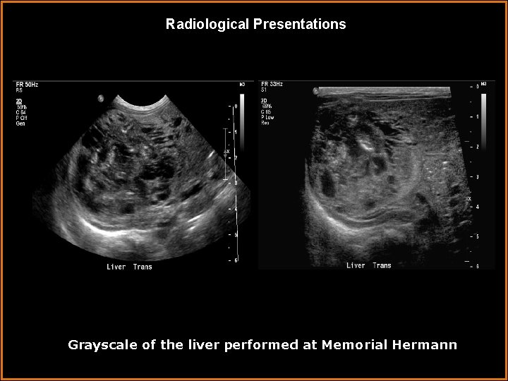 Radiological Presentations Grayscale of the liver performed at Memorial Hermann 