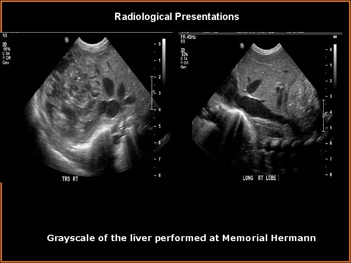 Radiological Presentations Grayscale of the liver performed at Memorial Hermann 