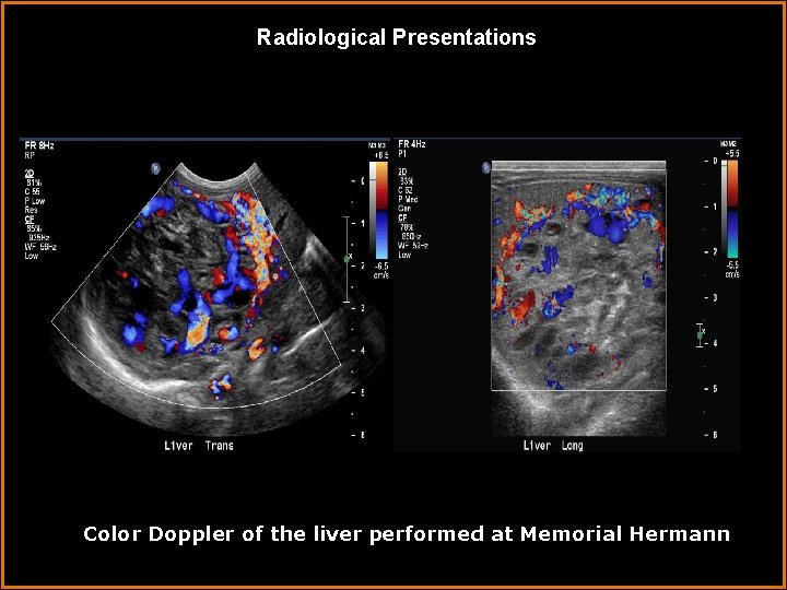 Radiological Presentations Color Doppler of the liver performed at Memorial Hermann 