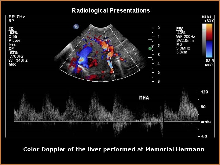 Radiological Presentations Color Doppler of the liver performed at Memorial Hermann 