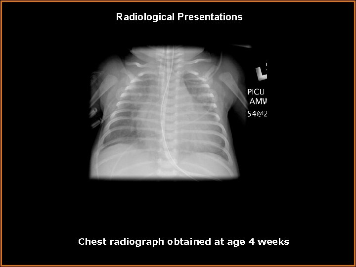 Radiological Presentations Chest radiograph obtained at age 4 weeks 