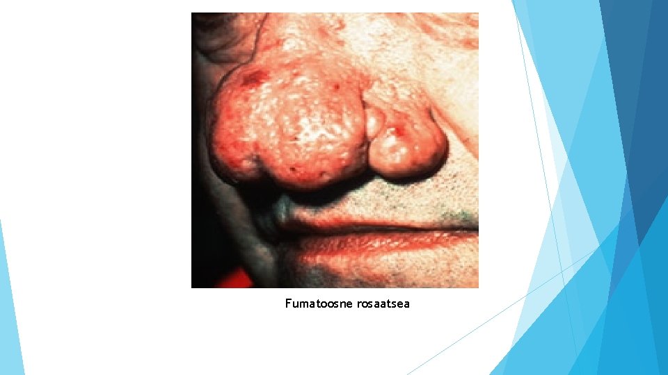 Fumatoosne rosaatsea Fumatoosne rosaatsea