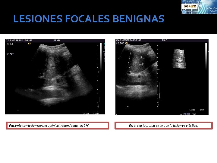 LESIONES FOCALES BENIGNAS Paciente con lesión hiperecogénica, redondeada, en LHI. En el elastograma se