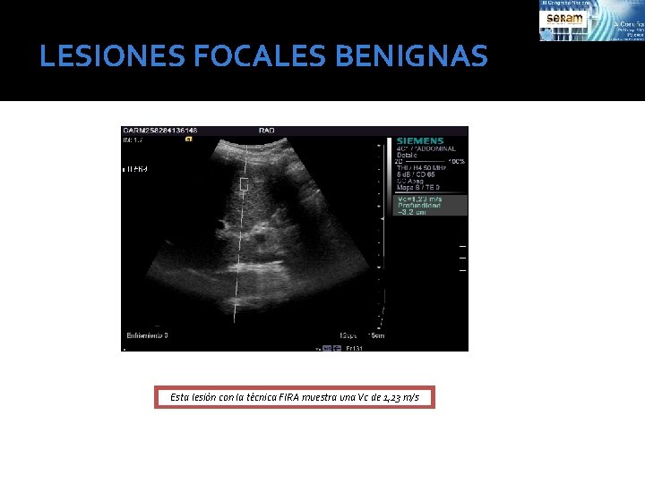 LESIONES FOCALES BENIGNAS Esta lesión con la técnica FIRA muestra una Vc de 1,