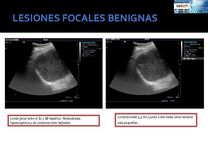 LESIONES FOCALES BENIGNAS Lesión focal entre el S 7 y S 8 hepático. Redondeada,