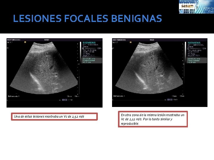 LESIONES FOCALES BENIGNAS Una de estas lesiones mostraba un Vc de 2, 52 m/s