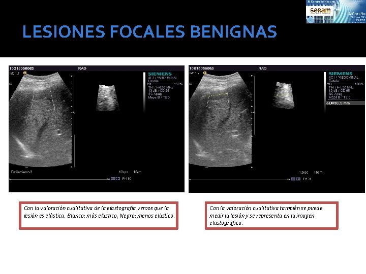 LESIONES FOCALES BENIGNAS Con la valoración cualitativa de la elastografía vemos que la lesión